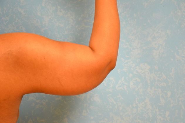 Arm Lift: Case 1510- Toledo, OH - After