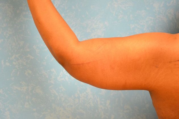 Arm Lift: Case 1510- Toledo, OH - After