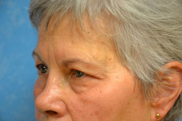 Eye Lift (Blepharoplasty): Case 1574- Perrysburg, OH - Before