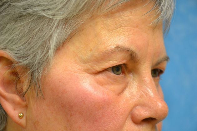 Eye Lift (Blepharoplasty): Case 1574- Perrysburg, OH - Before