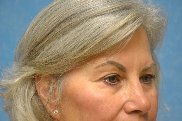 Eye Lift (Blepharoplasty): Case 1574- Perrysburg, OH - After