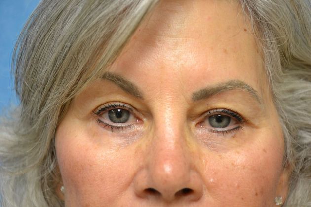 Eye Lift (Blepharoplasty) Case 1574- Perrysburg, OH - After