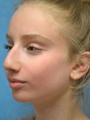 Rhinoplasty: Case 1411- Toledo, OH - Before