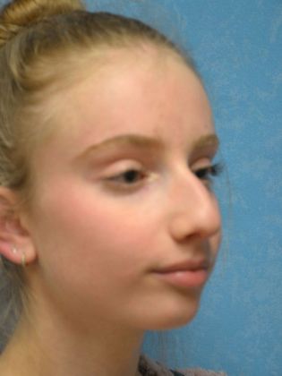 Rhinoplasty: Case 1411- Toledo, OH - Before