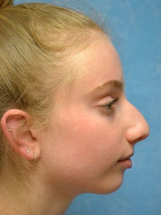 Rhinoplasty Case 1411- Toledo, OH - Before