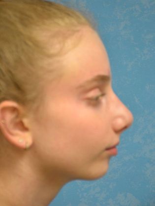 Rhinoplasty Case 1411- Toledo, OH - After