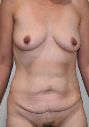 Mommy Makeover Case 218 - Before