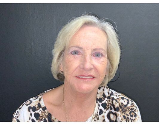 Facelift Case 15 - After