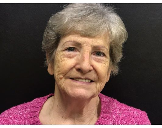 Facelift Case 15 - Before