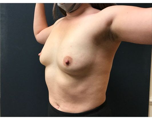 Breast Augmentation Case 30 - Before
