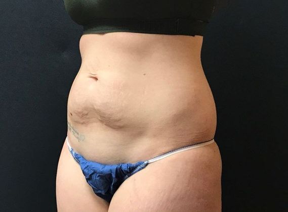 Abdominoplasty: Case 25 - Before