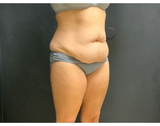 Abdominoplasty Case 26 - Before