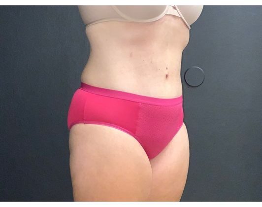 Abdominoplasty Case 26 - After