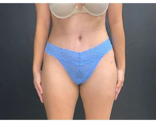 Abdominoplasty Case 27 - After