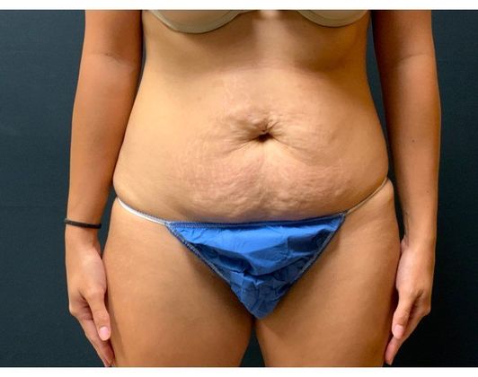 Abdominoplasty Case 27 - Before