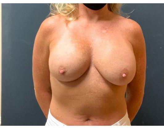 Mastopexy Case 20 - Before
