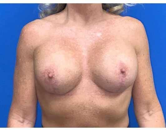 Mastopexy Case 20 - After