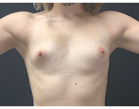 Breast Augmentation Case 33 - Before