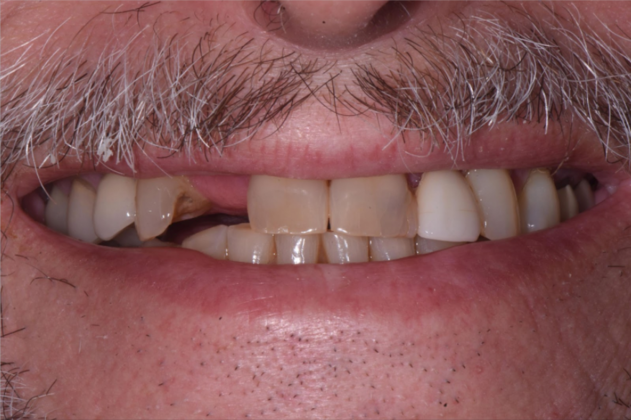 Full Mouth Rehabilitation with Crowns Case 1 - Before