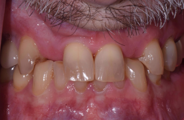 Full Mouth Rehabilitation with Crowns: Case 1 - Before