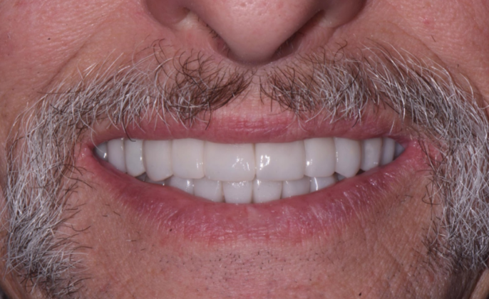 Full Mouth Rehabilitation with Crowns Case 1 - After