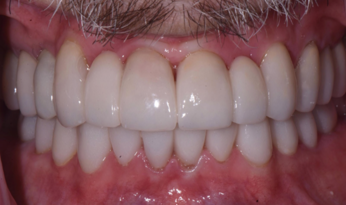 Full Mouth Rehabilitation with Crowns: Case 1 - After