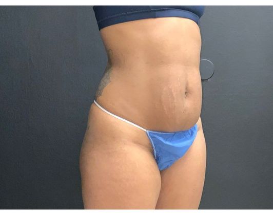 Abdominoplasty Case 28 - Before