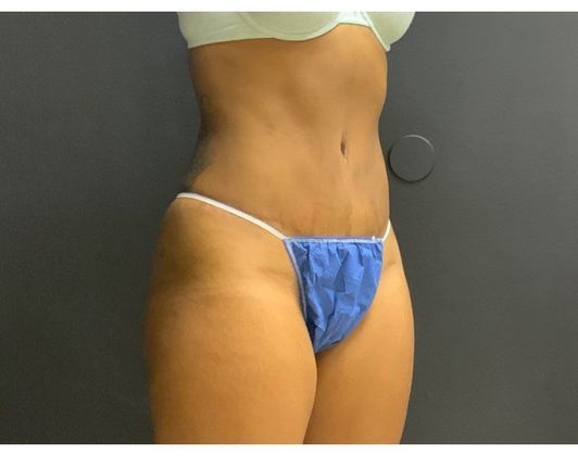 Abdominoplasty Case 28 - After