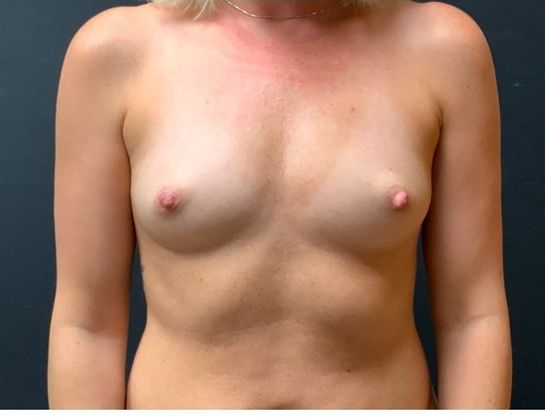 Breast Augmentation Case 34 - Before