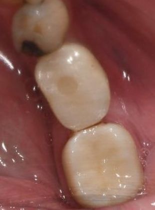 Dental Implants Case 18 - Victoria, TX - After