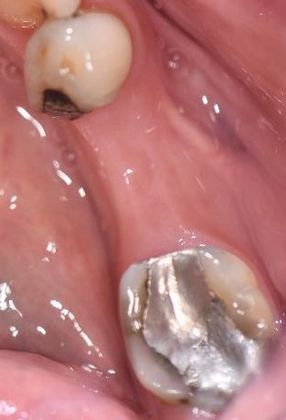 Dental Implants Case 18 - Victoria, TX - Before