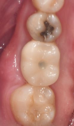 Dental Implants Case 19 - Victoria, TX - After