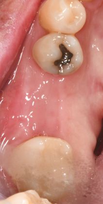 Dental Implants Case 19 - Victoria, TX - Before