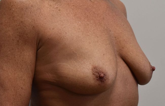 Breast Augmentation w/ Lift: Case 408 - Before