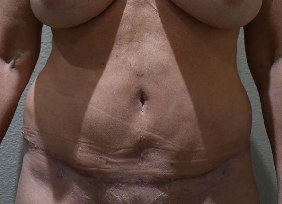 Tummy Tuck (Abdominoplasty): Case 328 - After