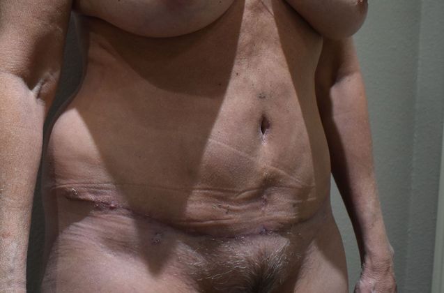 Tummy Tuck (Abdominoplasty): Case 328 - After