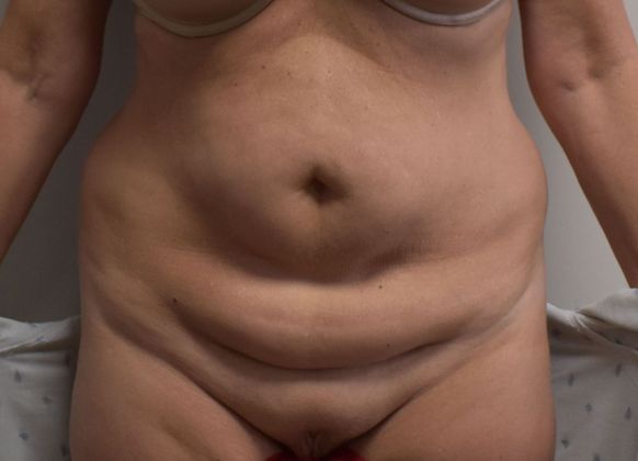 Tummy Tuck (Abdominoplasty): Case 328 - Before