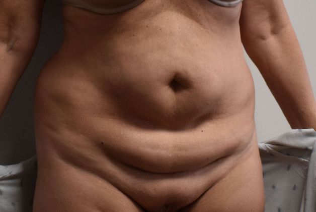 Tummy Tuck (Abdominoplasty): Case 328 - Before