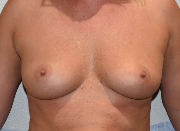 Breast Augmentation Case 772   - Before