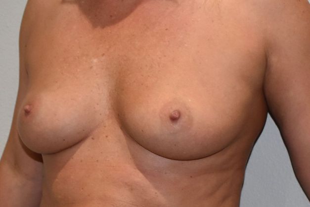 Breast Augmentation: Case 772 - Before