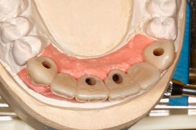 Dental Implants: Patient 5 - Screw Retained Bridges