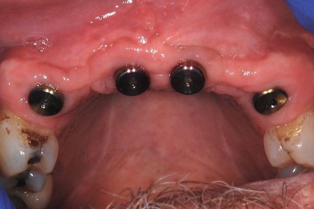 Dental Implants: Patient 5 - Before