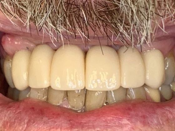 Dental Implants: Patient 5 - After