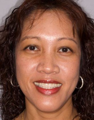 All On 4 Full Arch Restoration - The Fixed Hybrid Case