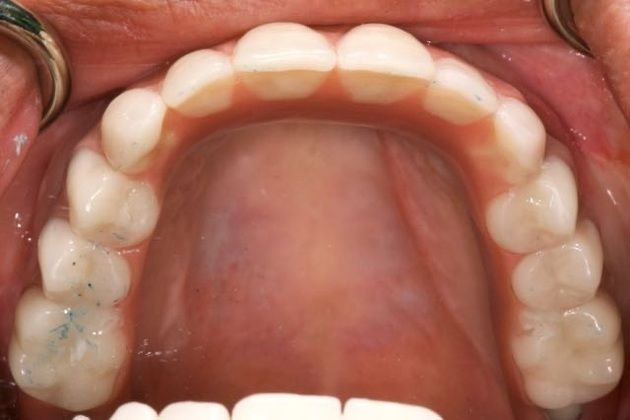 All On 4 Full Arch Restoration - The Fixed Hybrid: Double Arch Rehabilitation with All On 4 Full Arch Hybrid Restorations - Upper AllOn4