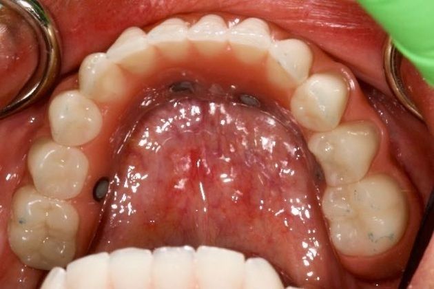 All On 4 Full Arch Restoration - The Fixed Hybrid: Double Arch Rehabilitation with All On 4 Full Arch Hybrid Restorations - Lower AllOn4