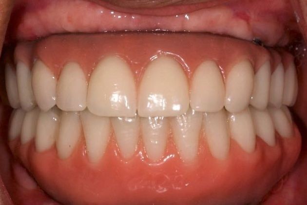 patient with all-on-4 supported dentures