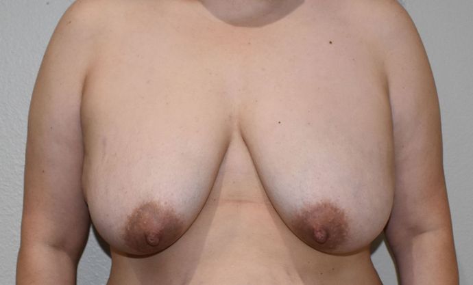 Breast Augmentation w/ Lift: Case 409 - Before