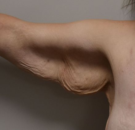Brachioplasty Case 17 - Before