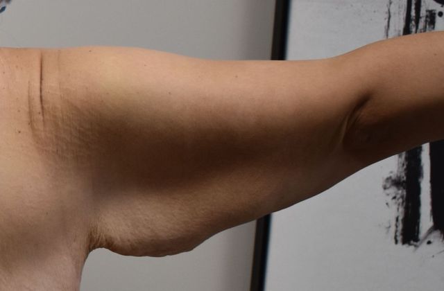Brachioplasty: Case 17 - Before